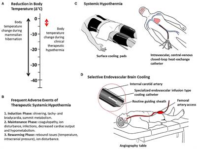 Selective Brain Hypothermia in Acute Ischemic Stroke: Reperfusion Without Reperfusion Injury